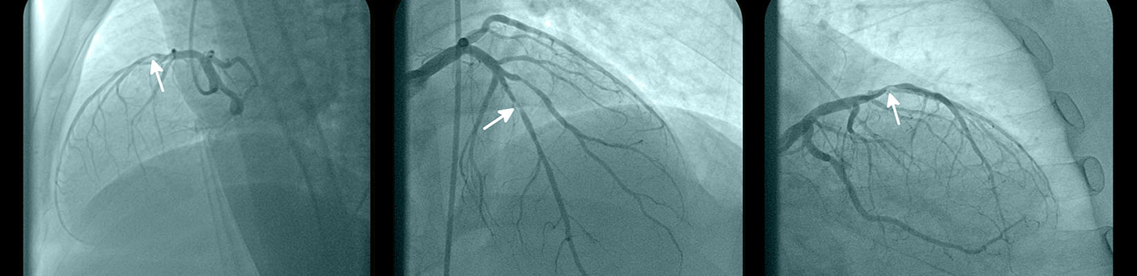 cardiac stent