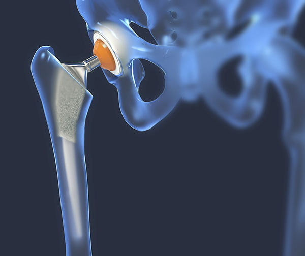 hip replacement